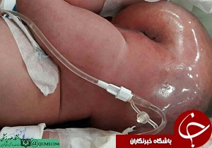 برداشتن توده از کمر نوزاد یک روزه