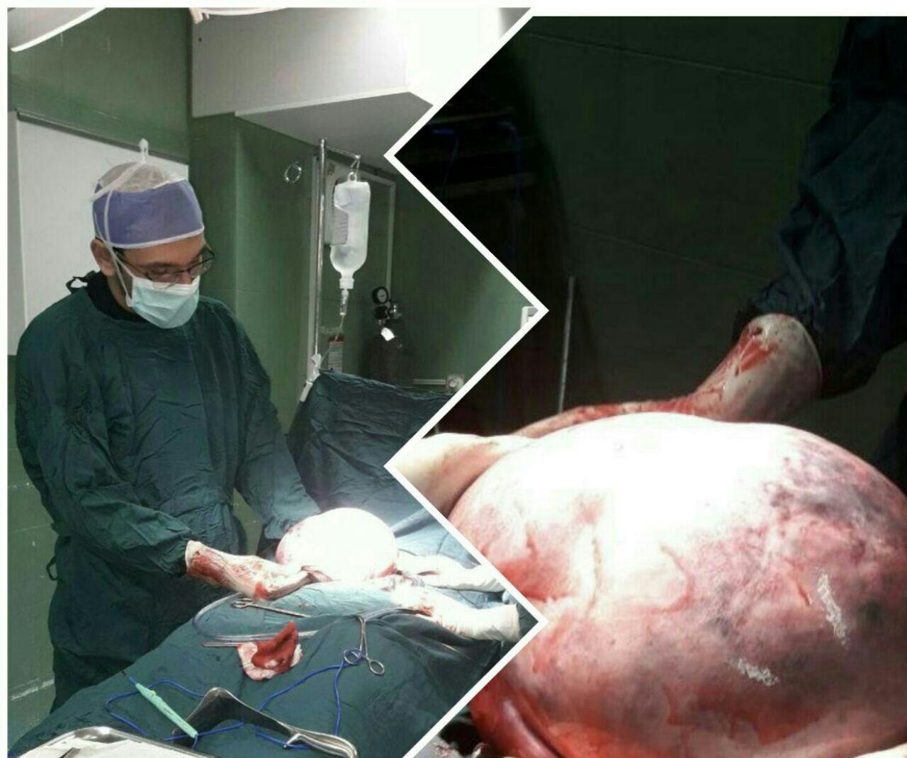 خارج کردن توده هفت کیلوگرمی از شکم بیمار کاشمری