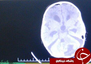 جراحی موفقیت آمیز برای خارج کردن تومور از سر یک کودک