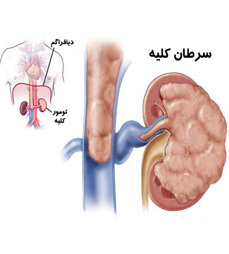 ماهانه ۱۵ میلیون تومان برای درمان بیماران سرطان کلیه هزینه می‌شود