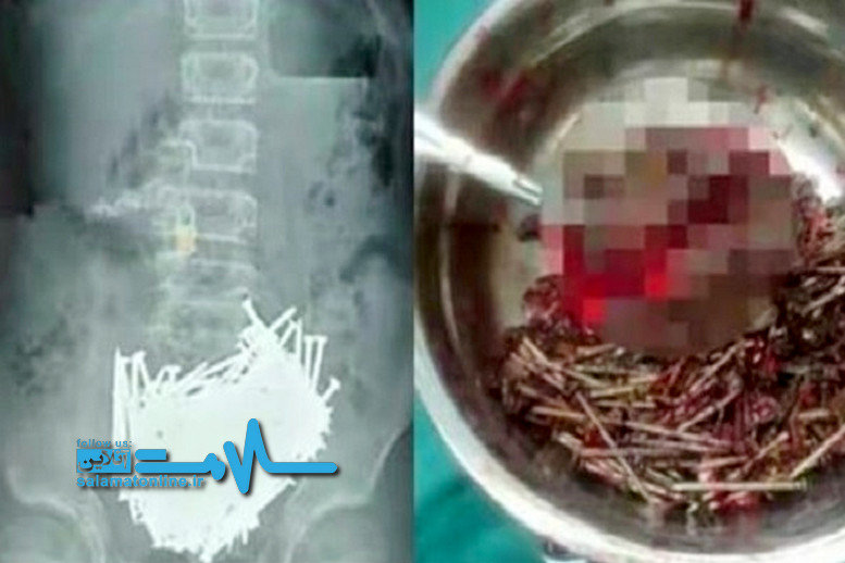 جراحان از معده مرد بنگال بیش از ۶۰۰ میخ آهنی خارج کردند