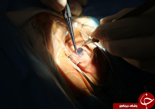 جراحى همزمان پیوند قرنیه، آب مروارید و کاشت لنز داخل چشمى در بابل + تصاویر
