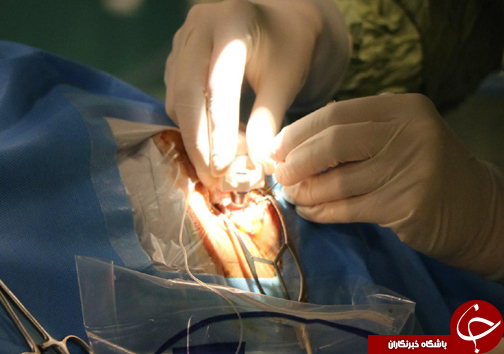 جراحى همزمان پیوند قرنیه، آب مروارید و کاشت لنز داخل چشمى در بابل + تصاویر