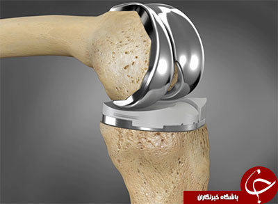 اگر این نشانه&zwnj;ها را دارید، مینیسک زانوی شما دچار پارگی شده است