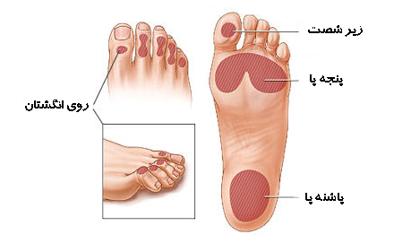 ترميم زخم پاى ديابتى با روشى جديد به كمک ليزر