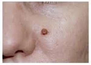خال کوچکی که تبدیل به یک تومور وحشتناک شد +عکس