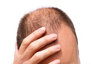 روش فوق العاده برای جلوگیری از ریزش موی سر