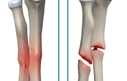 7 عامل شکننده شدن استخوان&zwnj;ها