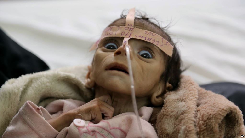سازمان ملل: یمن بدترین نقطه کره زمین برای یک کودک است