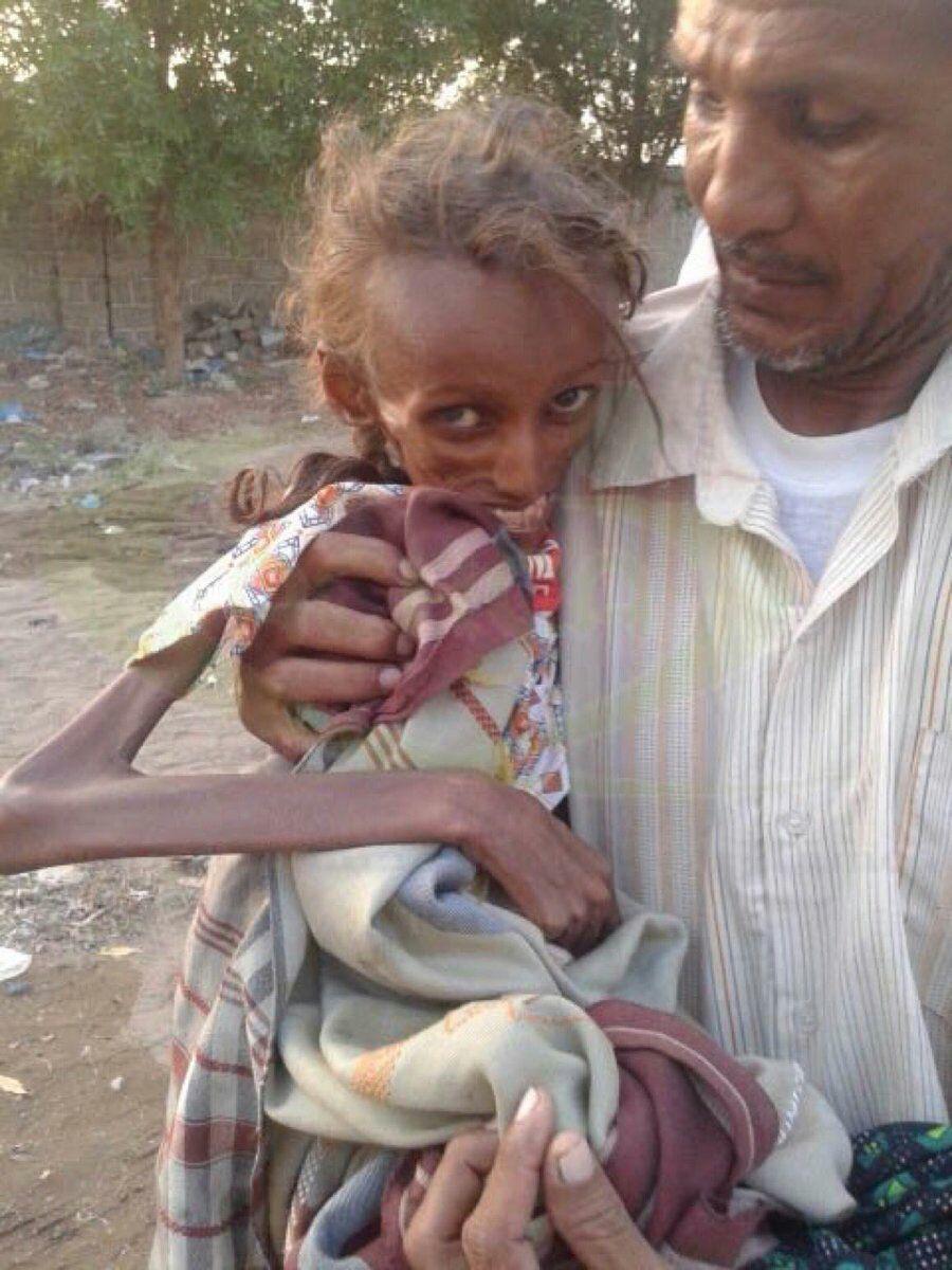 سازمان ملل: یمن بدترین نقطه کره زمین برای یک کودک است