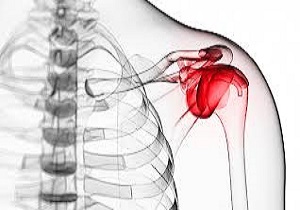 خبرنگار: جنیدی/ ویژه عید/عارضه یخ زدگی شانه چیست؟