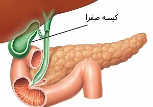 کیسه صفرا شایع ترین بیماری در زنان