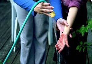 خبرنگار: جنیدیاقدامات اولیه پزشکی در مواجه با سوختگی با اسید چیست؟