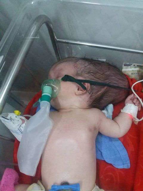 تولد نوزادی با نصف جمجمه در کامبوج + تصاویر