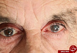 15 بره//خطرات تبدیل نور سفید به سیاه در چشم