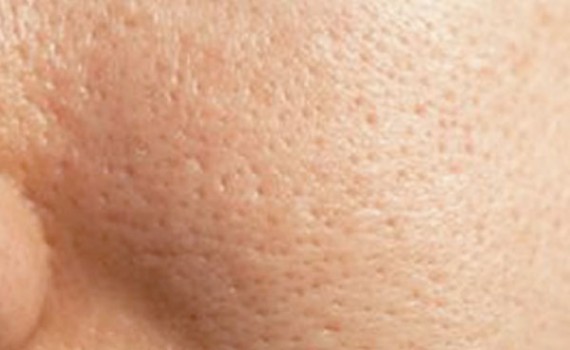 چگونه جای جوش را درمان کنیم؟