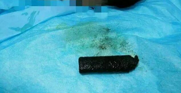 خارج کردن چراغ قوه از معده مرد چینی پس از 20 سال! فیلم///////////////////////
