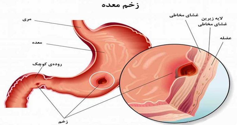 سندرمی که خود را با بی&zwnj;اشتهایی نشان می&zwnj;دهد اما به یکباره سیستم بدنی&zwnj;تان را مختل می&zwnj;کند
