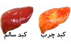 کبد چرب