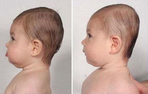 سندرم سر صاف یا پلاژیوسفالی در نوزادان + از علائم تا درمان این سندرم