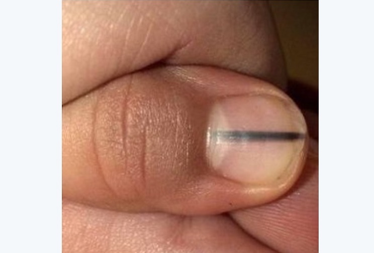 مشکلات ناخن که از بیماری خطرناک در بدن خبر می دهند! + تصاویر