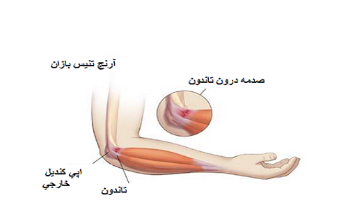 بیماری که استخوان آرنج را ملتهب می&zwnj;کند/ خطراتی که کشیده شدن تاندون روی استخوان به همراه دارد