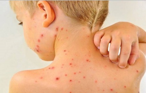 کنترل بیماری&zwnj;ها با رژیم غذایی مخصوص+ برنامه غذايى ویژه آبله مرغان