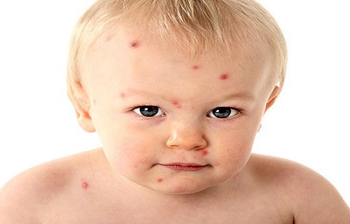 کنترل بیماری&zwnj;ها با رژیم غذایی مخصوص+ برنامه غذايى ویژه آبله مرغان