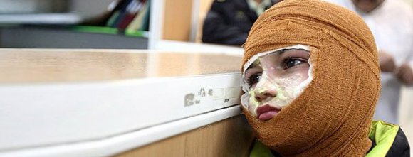آموزش پیشگیری از سوختگی در راستای فرهنگ سازی سلامت ضروری است