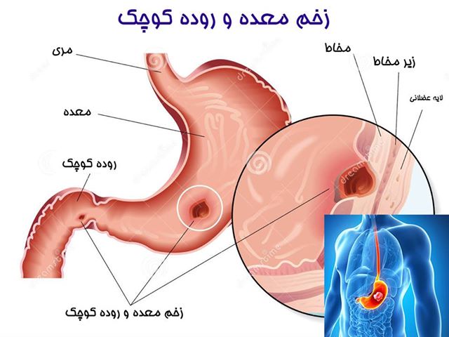 همه آنچه درباره زخم معده و دوازدهه باید بدانید+ رژیم غذایی و درمان