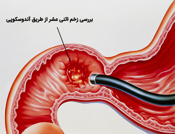 همه آنچه درباره زخم معده و دوازدهه باید بدانید+ رژیم غذایی و درمان