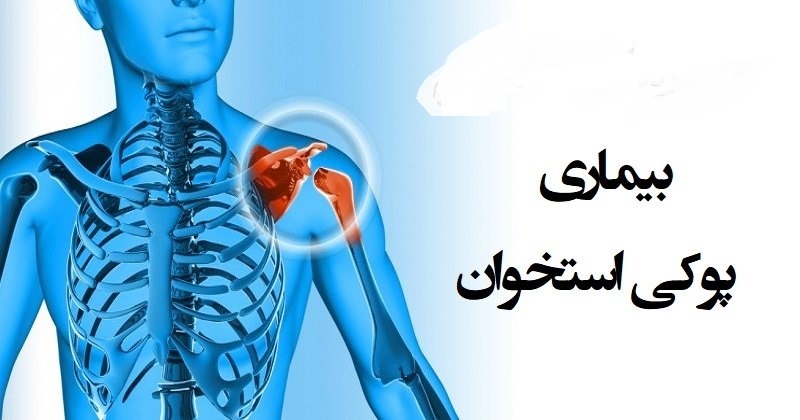 ۵۰ درصد بانوان بالای چهل سال گرفتار پوکی استخوان هستند