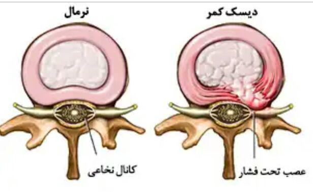 علل دیسک کمر