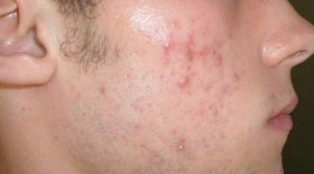 رژیم غذایی تاثیری در بهبود آکنه ندارد/ شست وشو بهترین روش برای پیشگیری از بروز آکنه