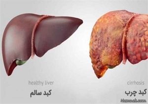 کبد چرب بیماری خاموش