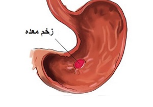 کدام خوراکی‌ها برای مبتلایان به زخم معده ممنوع است؟+ اینفوگرافی