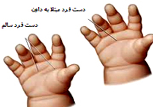 غربالگری سندروم داون در شیراز