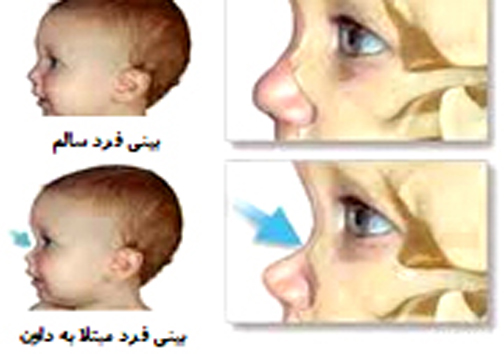 غربالگری سندروم داون در شیراز
