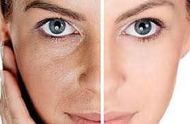 میکرونیدلینگ چیست و چه دردی از شما دوا می&zwnj;کند؟+ مزایا و معایب لایه&zwnj;برداری پوست