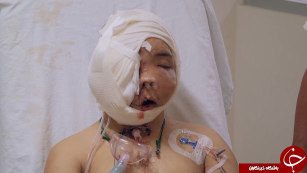 تغییر شکل عجیب صورت مرد جوان در اثر تومور وحشتناک! + فیلم