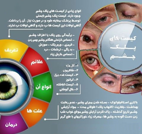 علائم کیست پلک چشم چیست؟+ اینفوگرافی