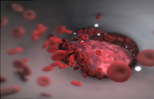 لخته&zwnj;های مرگ بار در کمین افراد کم تحرک/ از آمبولی ریه چه می&zwnj;دانید؟
