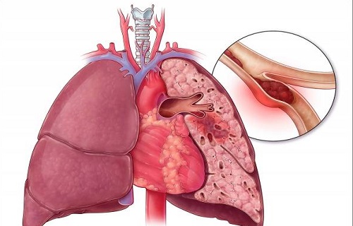 لخته&zwnj;های مرگ بار در کمین افراد کم تحرک/ از آمبولی ریه چه می&zwnj;دانید؟