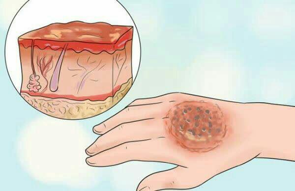 اختراع پماد التیام‌بخش سریع زخم‎های سوختگی