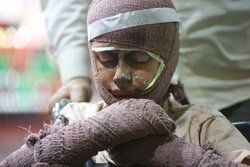 نوجوان 13 ساله بر اثر انفجار مواد محترقه دچار سوختگی شد