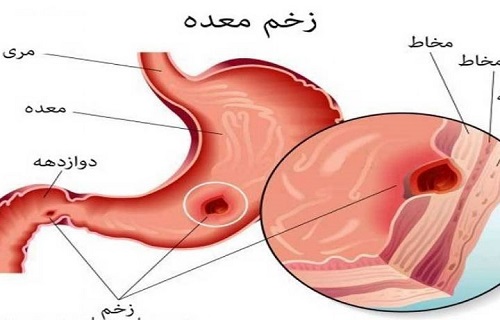 رژیم غذایی ویژه برای کنترل و بهبود بیماری&zwnj;ها+ توصیه&zwnj;های تغذیه&zwnj;ای برای زخم معده
