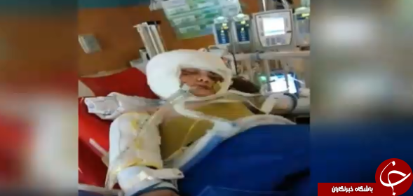 سگ وحشی گوش دختر سه ساله را از صورتش جدا کرد+تصاویر