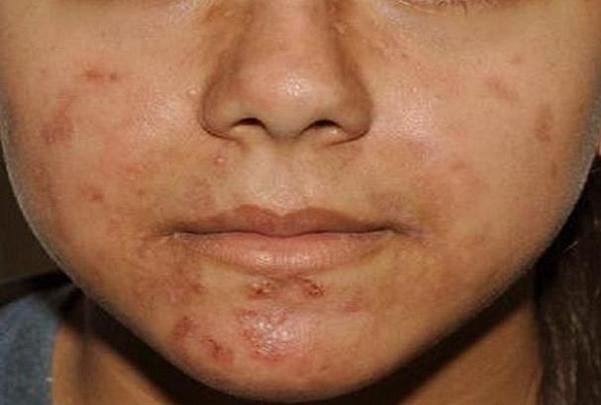 با این خوراکی&zwnj;ها از بوجود آمدن آکنه پیشگیری کنید!
