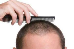 چگونه رشد موی سر را افزایش دهیم؟