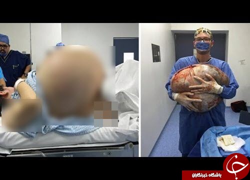 خارج کردن تومور سرطانی 60 کیلویی از شکم زن جوان + عکس خارج کردن تومور سرطانی 60 کیلویی از شکم زن جوان + عکس